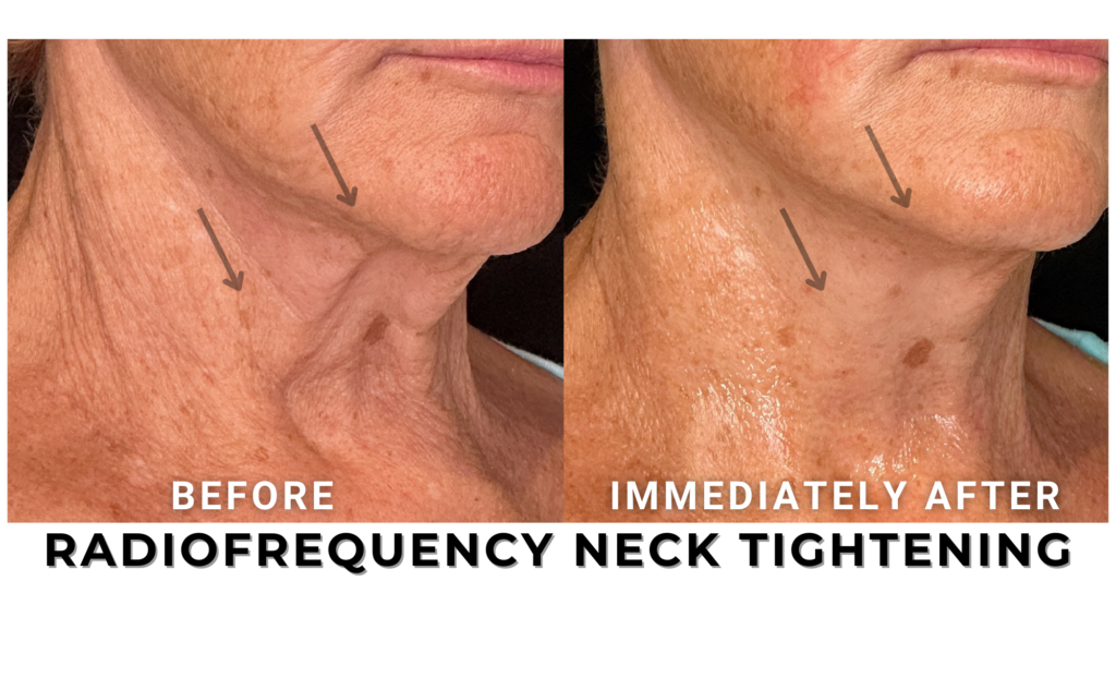 RF NECK TIGHTENING (2)
